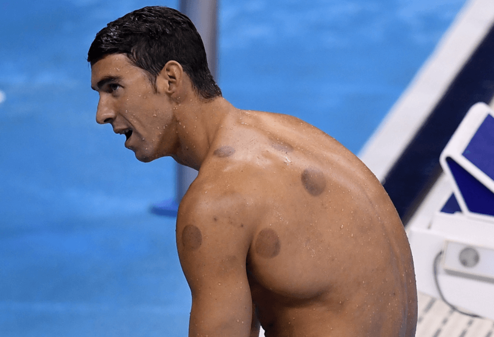 Phelps Cupping